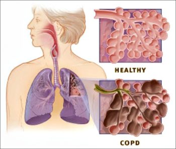 Chronic Obstructive Pulmonary Disease (COPD) 